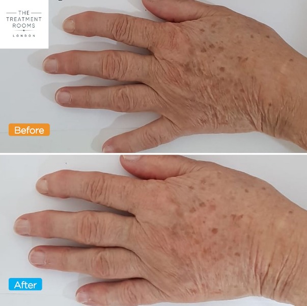 Hand rejuvenation